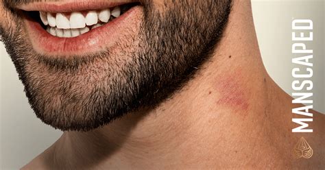 Hickeys: What You Need to Know